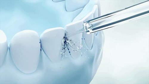 Diş teli kullanıcıları için su iplikçilerinin faydaları
